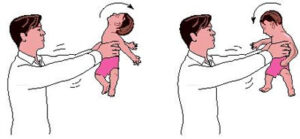 متلازمة هزِّ الرضيع